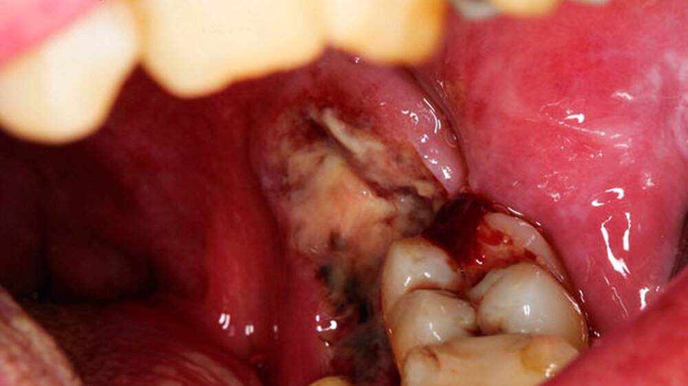 Abb. 1: Klinischer Befund bei Erstvorstellung: Es zeigt sich distal des Zahnes 37 eine mit Fibrin belegte Ulzeration, die marginal bis an Zahn 36 heranreicht. Nach lingual stellt sich der Befund eher granulomatös dar.