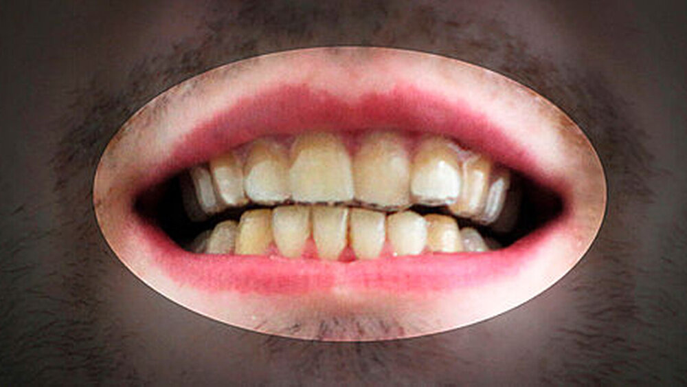 10. „Schließlich seht Ihr hier die beiden Bilder, die Euch wahrscheinlich am meisten interessieren“ – Dudley vor seiner „Zahnschienen-Therapie“ ... |