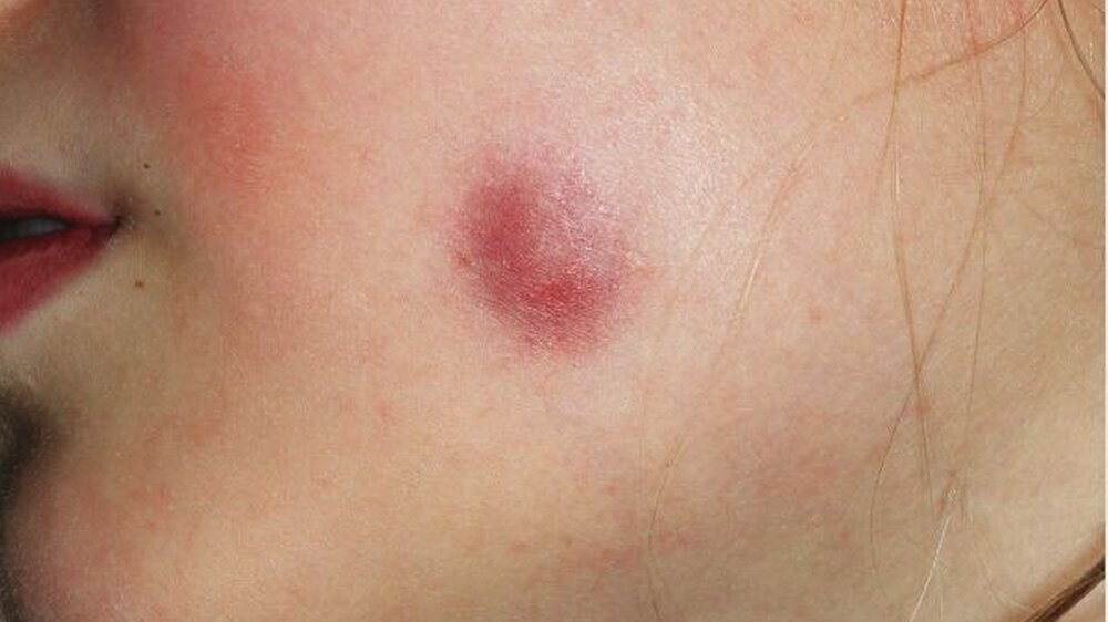 Abbildung 1: klinischer Aspekt der Schwellung mit umschriebener Rötung und teilweiser Verkrustung im Bereich der linken Wange