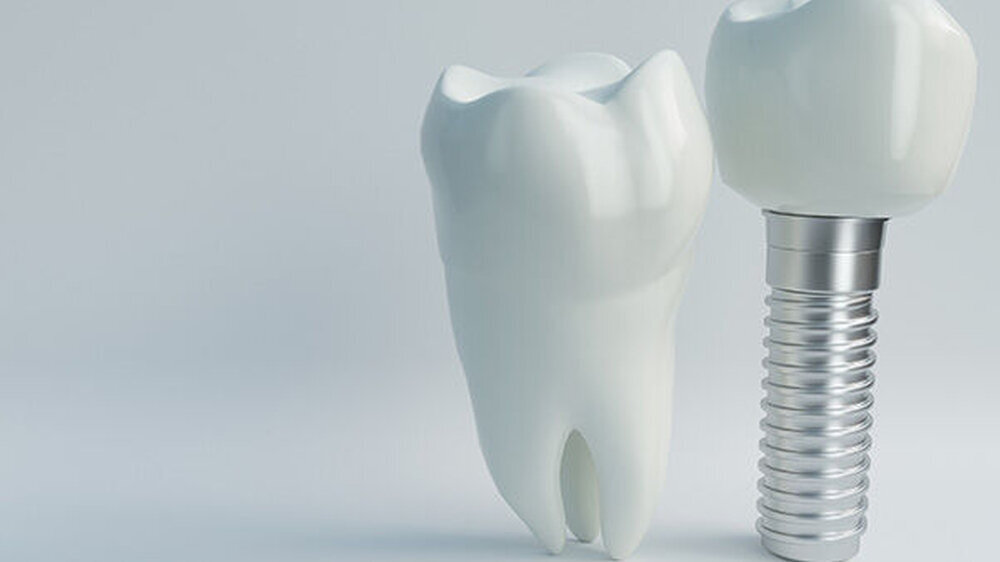 Die an der Universität Groningen entwickelte chirurgische Schablone ermöglicht unter Ausnutzung der Nasenöffnung eine stabile und sichere Platzierung des Implantats auf dem Knochen von zahnlosen atrophischen Oberkiefern.