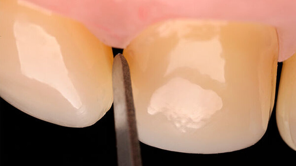 Besonders schallaffine Praxen wird die folgende Nachricht freuen: Die VeneerFinisher von Komet Dental sind jetzt ergänzend zum Perfect Veneer Preparations (PVP) Set erhältlich.