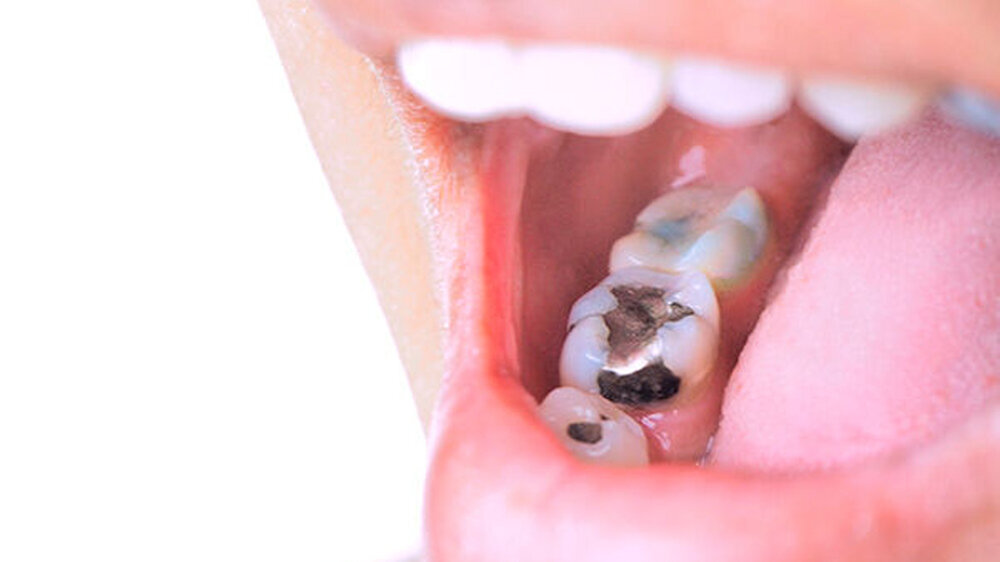 Bis zum 30. Juni 2020 wird die EU-Kommission klären, ob auf lange Sicht beziehungsweise bis 2030 ein vollständiger Ausstieg aus der Nutzung von Dentalamalgam möglich ist.