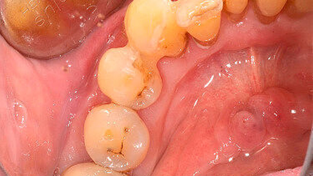 Abbildung 7: Postoperative Situation nach sechs Monaten |