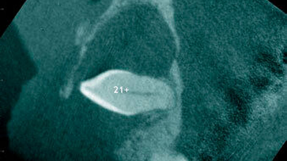 Abbildung 19: Überzähliger Zahn im Oberkieferfrontbereich (21+) mit zystischer Erweiterung des Zahnsäckchens und radiologisch erkennbarer Resorption der mesialen Wurzel von 11 bei einem 46-jährigen Patienten (b: sagittaler Schnitt).  |
