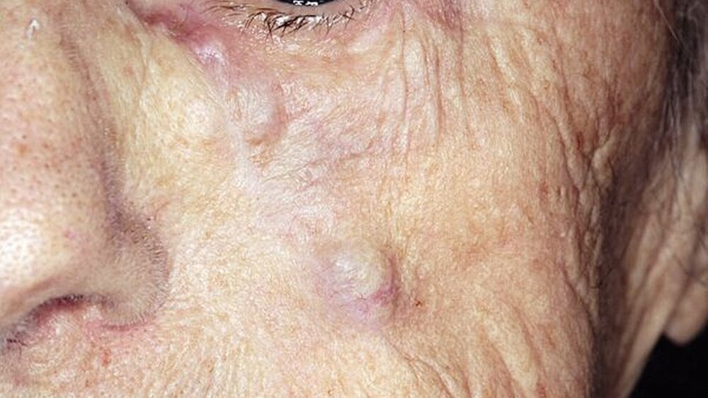 Abbildung 1: Extraoraler Befund: mehrere knotige Raumforderungen entlang einer Narbe im Bereich der Wange links. |