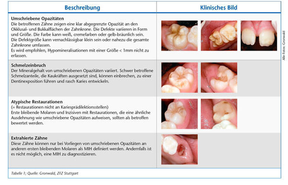 Behandlung Von MIH Patienten Zm online behandlung-von-mih-patienten-zm-online