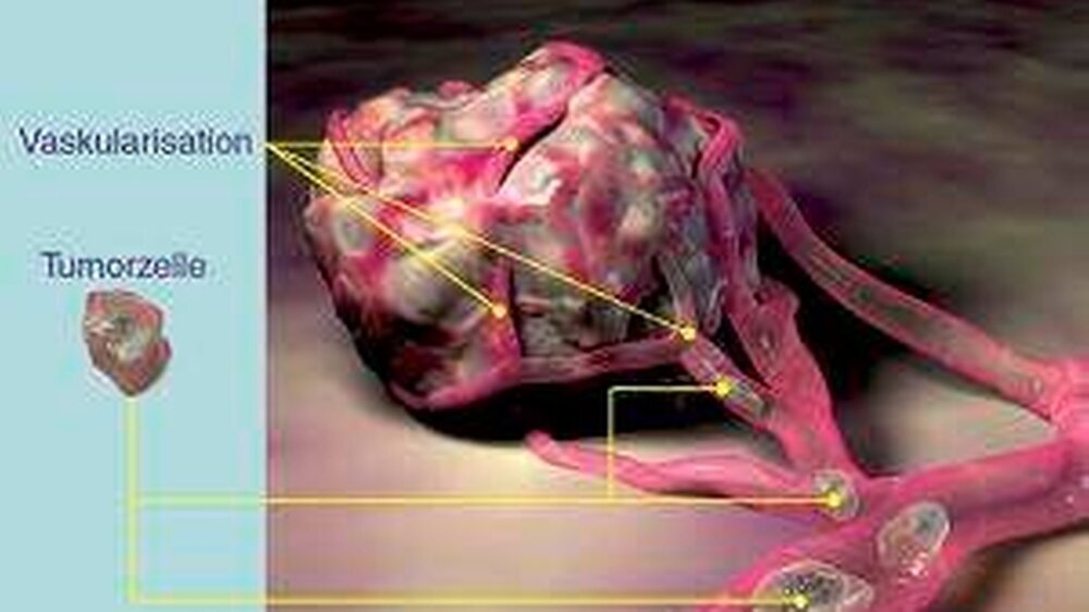 Tumorzellen bilden Wachstumsfaktoren und veranlassen so den Körper zur Ausbildung neuer Blutgefäße, die den Tumor dann mit Nährstoffen versorgen. Eine neue Strategie in der Krebstherapie besteht in spezifischen Antikörpern, die die Bildung der Wachst