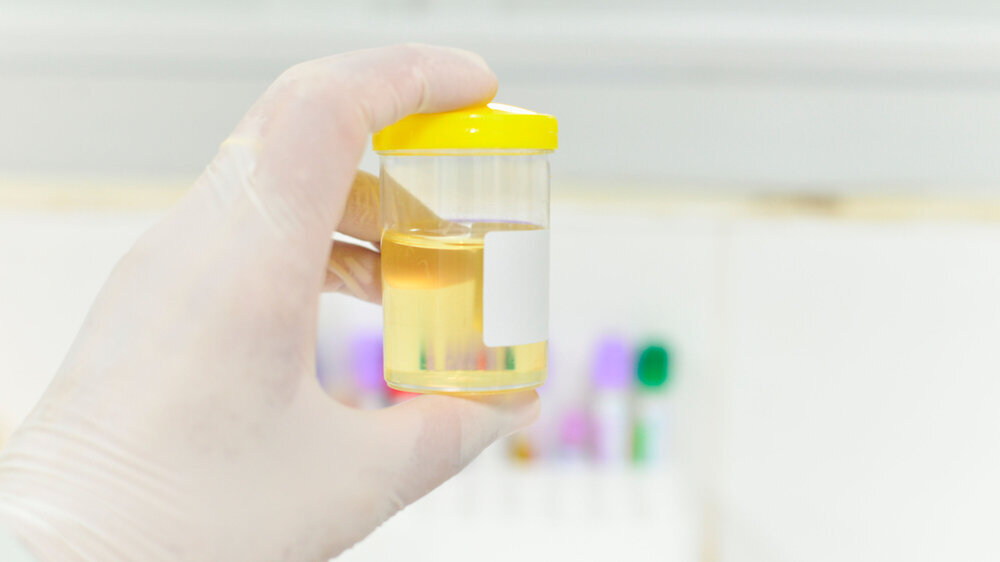 Check-up. Medical report and urine test strips Urintest