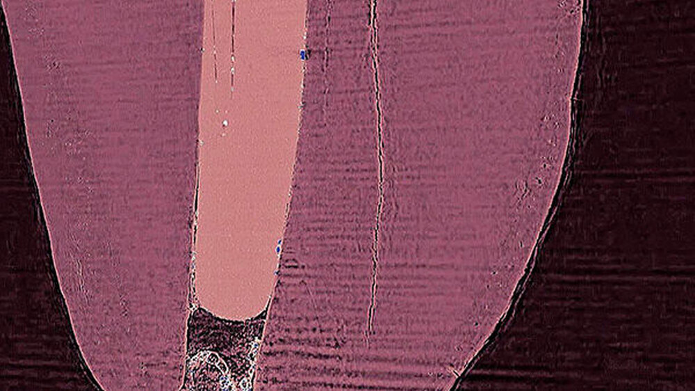 An BESSY II konnten die Forscher mithilfe der besonders hochauflösenden Computertomografie Details an der Grenze zwischen Füllung und Zahnwurzel die ikrorisse in der Zahnsubstanz genau vermessen und untersuchen.