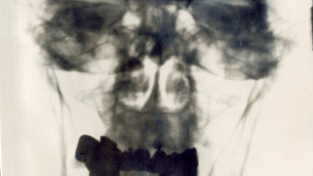 Diese zu Lebzeiten aufgenommene Röntgenaufnahme von Adolf Hitler liegt in der U.S. National Library of Medicine und diente den Wissenschaftlern als Grundlage für die Zuordnung der Zahnreste.