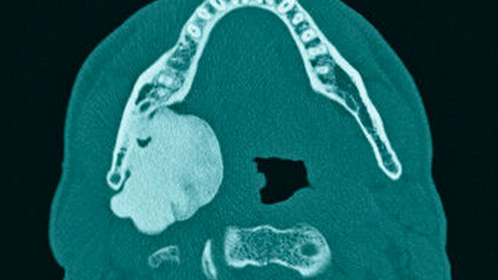 Abbildung 2: Coronale Schicht eines Dental-CTs mit Darstellung einer glatt begrenzten, knöchernen Raumforderung. |