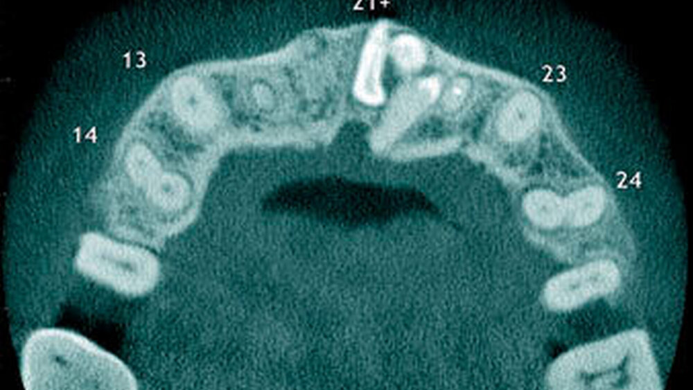 Abbildung 12: Überzähliger Zahn im Oberkieferfrontbereich (21+) mit einer konischen Form sowie ein zusammengesetztes Odontom disto-kaudal dieses überzähligen Zahnes bei einem 14-jährigen Knaben (c: axialer Schnitt)  |
