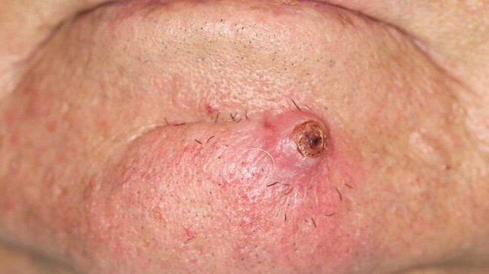Abbildung 1: klinischer Aspekt bei Erstvorstellung: derb-knotiger Tumor mit Ulzeration der Haut mental links