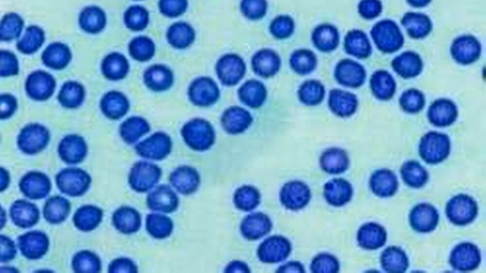 Abb. 1: Ausschnitt aus dem Blutausstrich des 56-jährigen Patienten mit verschleppter Malaria tropica am zweiten Behandlungstag. Die „ringförmigen“ Trophozyten zeigen die von den Parasiten befallenen roten Blutzellen und geben einen Anhalt für die b