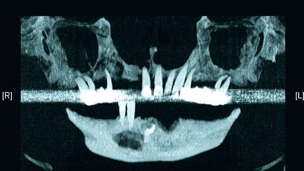 Abbildung 1: Präoperative OPG-Rekonstruktion aus dem CT: zystische Läsion mit Wurzelrest im vierten Quadranten, horizontaler Knochenabbau im Oberkiefer mit osteolytischen Prozessen. |