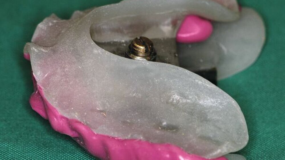 Abbildung 8: Laborgefertigte Registrierbehelfe nach intraoraler Verschlüsselung. |