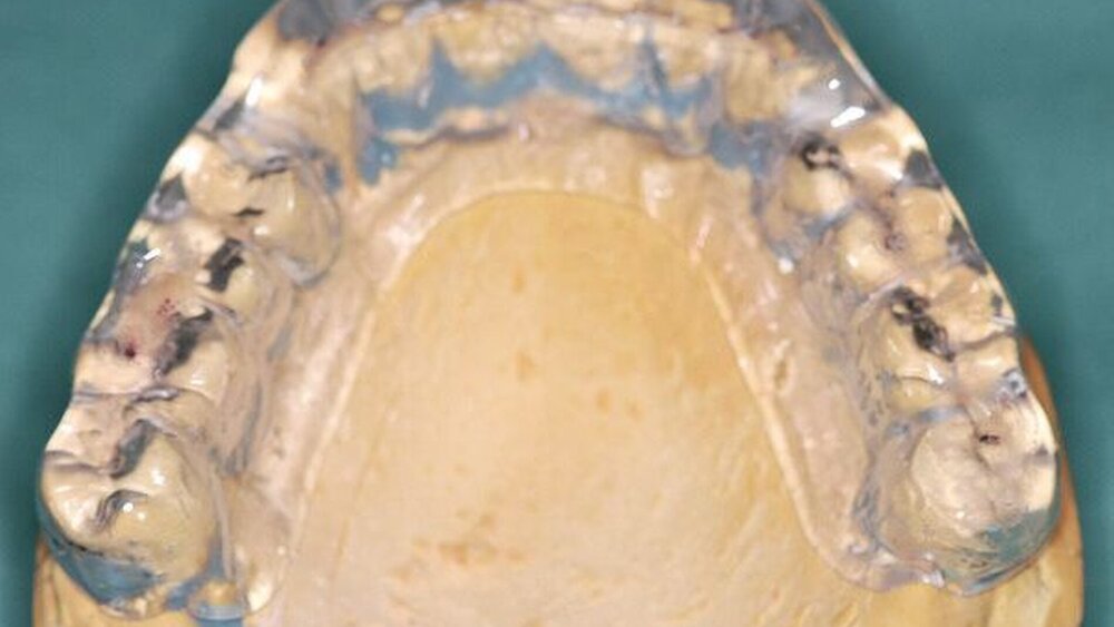 Abbildungen 10a, 10b: Okklusal adjustierte Stabilisierungsschiene. |