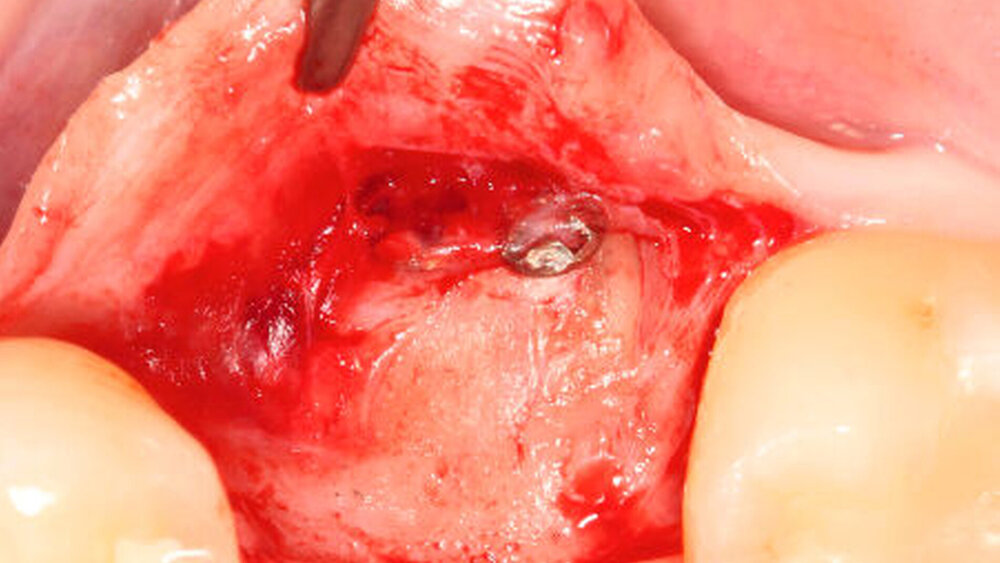 Abbildung 5a: Klinische Situation sechs Monate nach einer lateralen Kieferkammaugmentation unter Verwendung einer Zahnwurzel im Menschen. Analog zu den Ergebnissen im Tiermodell zeigen sich deutliche Anzeichen für eine Ersatzresorption. |