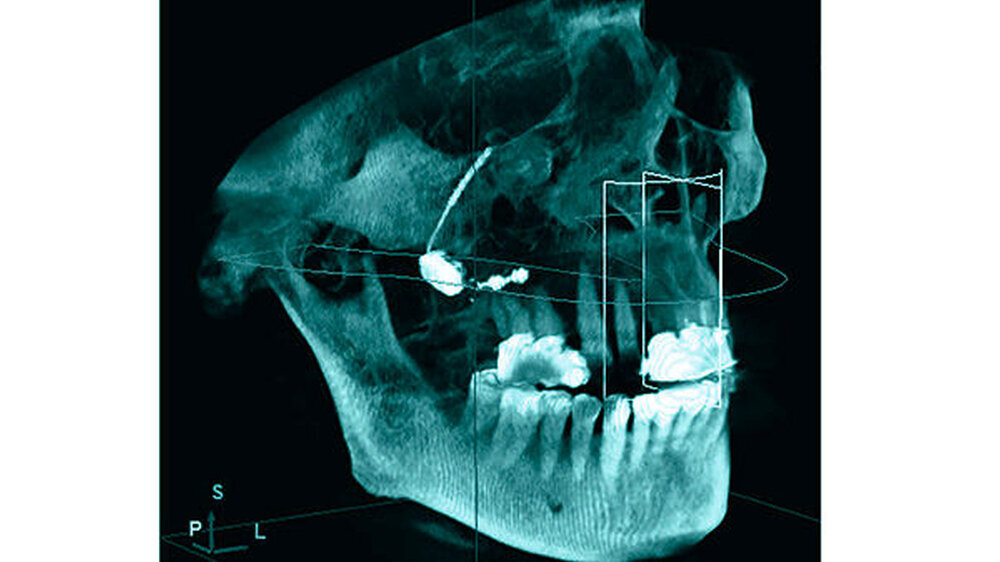 Abbildung 1: Postoperatives digitales Volumentomogramm mit Lage des Stimulators an der Schädelbasis hinter und oberhalb des Oberkiefers in der Fossa pterigopalatina am Nervus vidianus.