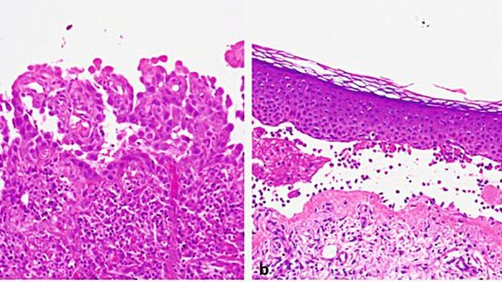 Abbildung 7: Die Histopathologie einer läsionalen Probebiospie erlaubt die Höhe der Spaltbildung zu bestimmen: intraepithelial/intraepidermal beim Pemphigus und subepidermal/subepithelial bei Pemphigoiderkrankungen und Dermatitis herpetiformis Duhring. a: Pemphigus vulgaris: suprabasale Spaltbildung, b: Bullöses Pemphigoid: subepidermale Spaltbildung |