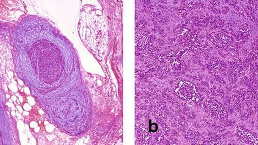 Abbildung 3: Histopathologischer Befund (a: Vergrößerung 20-fach, b: Vergrößerung 50-fach): für einen peripheren primitiven neuroektodermalen Tumor typische Histologie und Zytologie; infiltrativ wachsender, zelldichter, knotiger nichtorganoider Tumor mit kleinen runden undifferenzierten Tumorzellen; die Kerne relativ zu groß und hyperchromatisch, Mitosen vereinzelt; fibromuzinöses Stroma, teilweise kapselartige Fibrose um die Tumorknoten; die Tumorzellen positiv gegenüber S100 und neuronspezifische Enolase, Pan-CK, CK7 und 20, CEA, Melan-A, HMB45 negativ. |