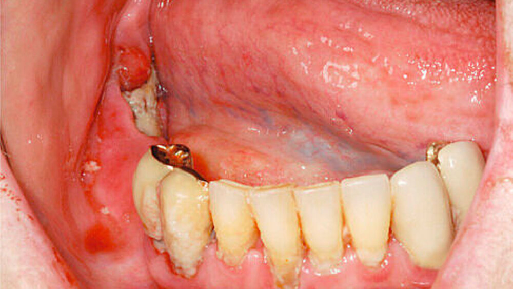 Abbildung 5: Enorale Aufnahme einer freiliegenden Knochenstelle einer Denosumab-assoziierten Kiefernekrose mit entzündlich geschwollener Gingiva im Randbereich des Defekts, eine deutlich verminderte Mundhygiene als Nebenbefund |