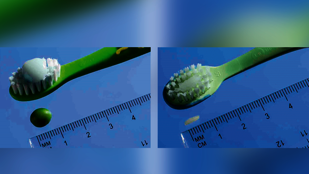 Abb. 1: Erbse und Reiskorn mit Zahnpaste: Fluoride
und insbesondere die fluoridierte Zahnpaste (jetzt
mit 1.000 ppm Fluorid) spielen eine zentrale Rolle
in der Kariesprävention, auch schon beim Kleinkind.\r\n