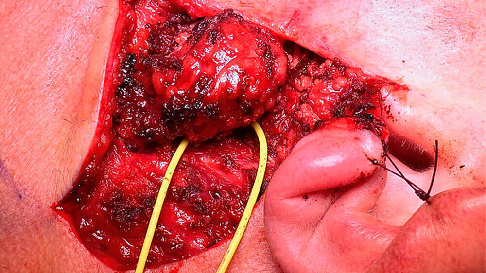 Dieser Tumor war ein Zufallsbefund. | Dieser Tumor war ein Zufallsbefund. |