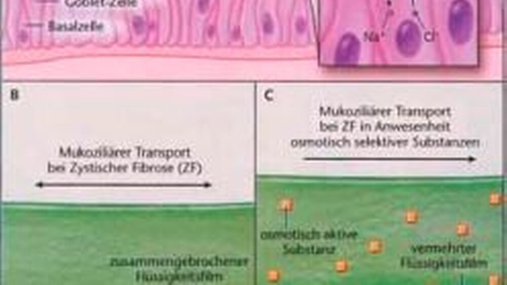 Abbildung 1: Mukoziliärer Transport in den Atemwegen gesunder Menschen beziehungsweise von Patienten mit ZF vor und nach Applikation von osmotisch aktiven Substanzen wie Kochsalz.\r\n(Quelle: Ratjen, NEJM 2006)