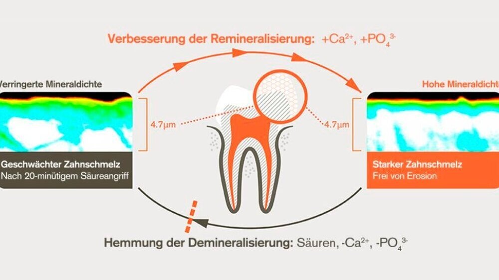 Sensodyne ProSchmelz fördert die Remineralisierung und reduziert die Demineralisierung des Zahnschmelzes. Weitere Informationen finden Sie auf unserem Portal.