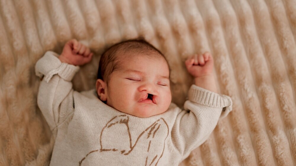 A sleeping newborn baby with congenital defect of cleft lip and palate wrapped in a cozy blanket, resting peacefully in a crib. The baby has a serene expression A sleeping newborn baby with congenital defect of cleft lip and palate wrapped in a cozy blanket, resting peacefully in a crib. The baby has a serene expression