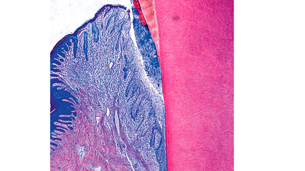 Abb. 1: Histologische Ansicht eines Zahnes mit einer parodontalen Tasche: Auf dem zervikalen Schmelz befindet sich Zahnstein, der von Biofilm bedeckt ist, der sich nach apikal und subgingival auf die Wurzeloberfläche erstreckt.