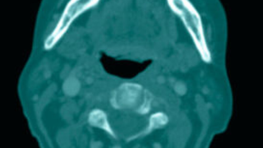 Abbildung 5: Axiale Computertomografie im Knochenfenster auf derselben Höhe wie Abbildung 4 mit deutlicher, vestibulär betonter Arrosion des Unterkieferknochens, zusätzliche apikale Osteolyse im Bereich des Zahns 45 und auf Basis einer ehemaligen ebenfalls pathologisch erweiterten Alveole im Bereich des Zahns 36. |