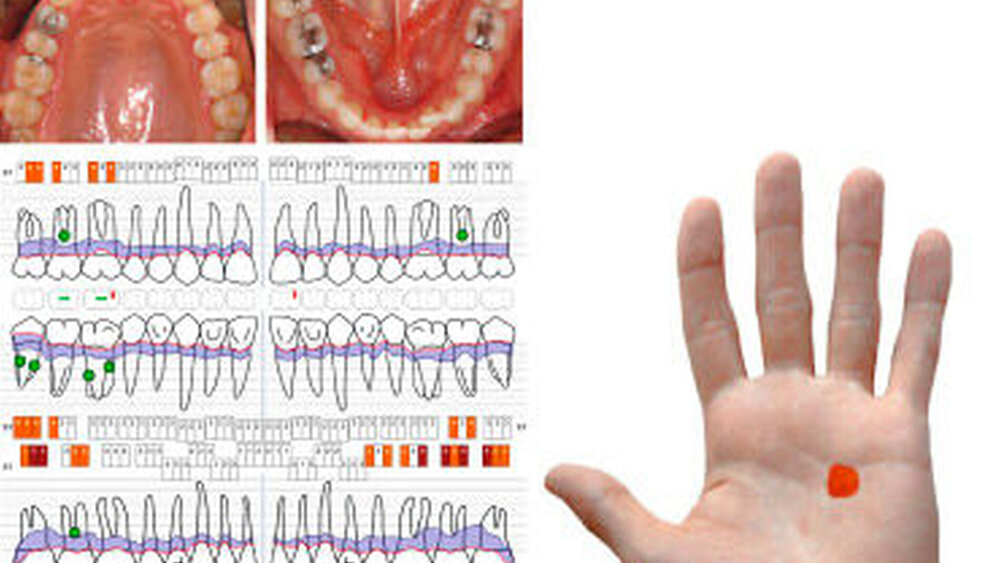 Abbildung 6: Patientenfall – Teil 2: Intraoraler Fotostatus und Attachmentstatus acht Wochen nach der Therapie: Die rote Färbung in der dargestellten Handfläche die verbliebende Gesamtentzündungsfläche von 108 mm2 (PISA-Score) zum Zeitpunkt der Reevaluation nach der Phase der antiinfektiösen Therapie. (Die Abbildungen des Attachmentstatus und der Handfläche wurden mithilfe des Programms ParoStatus.de generiert.) |