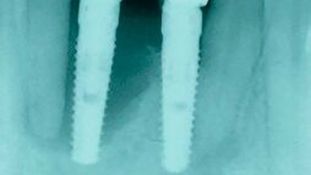 Abbildung 4b: Ausgehend von der Mukositis (Abbildung 4a) hat sich eine „tiefreichende“ Periimplantitis entwickelt. |