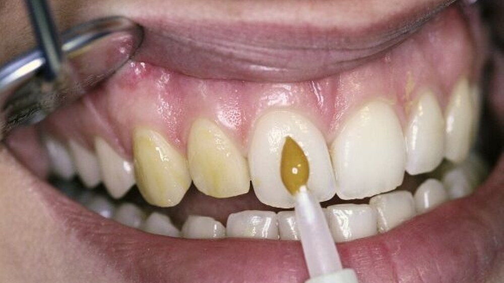Lokale Fluoridierung einer 23-jährigen Patientin
