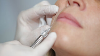 Faltenunterspritzung mit Hyaluronsäure