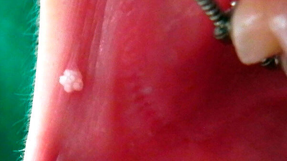 Abbildung 1: Zwölfjährige Patientin mit enoraler Verruca vulgaris, retroangulär rechts gelegen Abbildung 1: Zwölfjährige Patientin mit enoraler Verruca vulgaris, retroangulär rechts gelegen