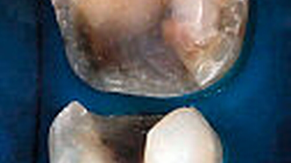 Fallbeispiel Abbildung 2: Präparation der Zähne für minimalinvasive Inlays und Onlays |