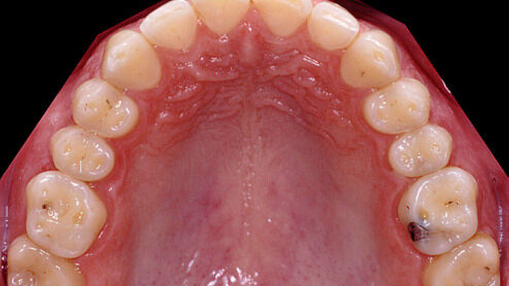 Abbildung 2: Ausgangssituation: generalisierte Abrasionen mit erosiver Komponente an allen OK- und UK-Zähnen |