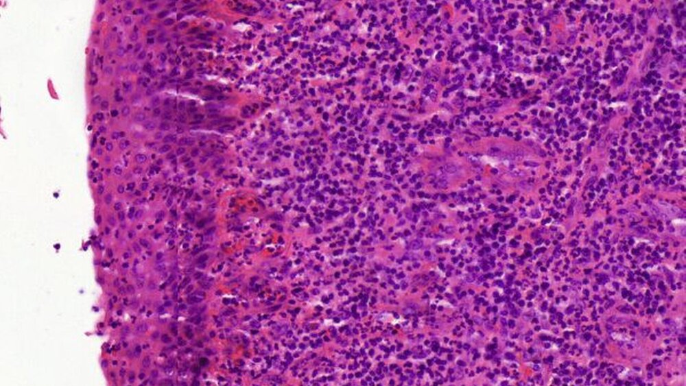 Abbildungen 6a und 6b: Das pathologische Gutachten lieferte die Diagnose einer plattenepithelialen Zyste mit fibrosiertem Zystenbalg und abschnittsweise entwickeltem Carcinoma in situ (pTis) des auskleidenden Plattenepithels bei Fehlen eines invasiven Karzinoms [mit freundlicher Überlassung durch R. Krupar, Pathologie im Uniklinikum Regensburg]. Nebenbefundlich zeigte sich eine chronisch-rezidivierende, floride Entzündung im Bereich der Nasennebenhöhlenschleimhaut. |