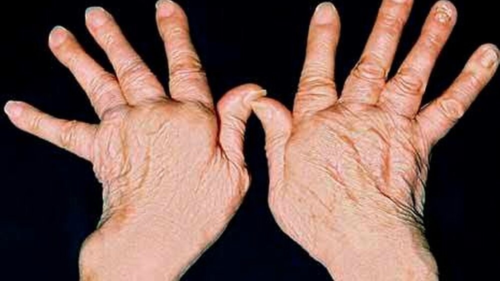 Durch Rheuma verkrüppelte Finger und Hände können nicht mehr richtig greifen und große Schmerzen verursachen.