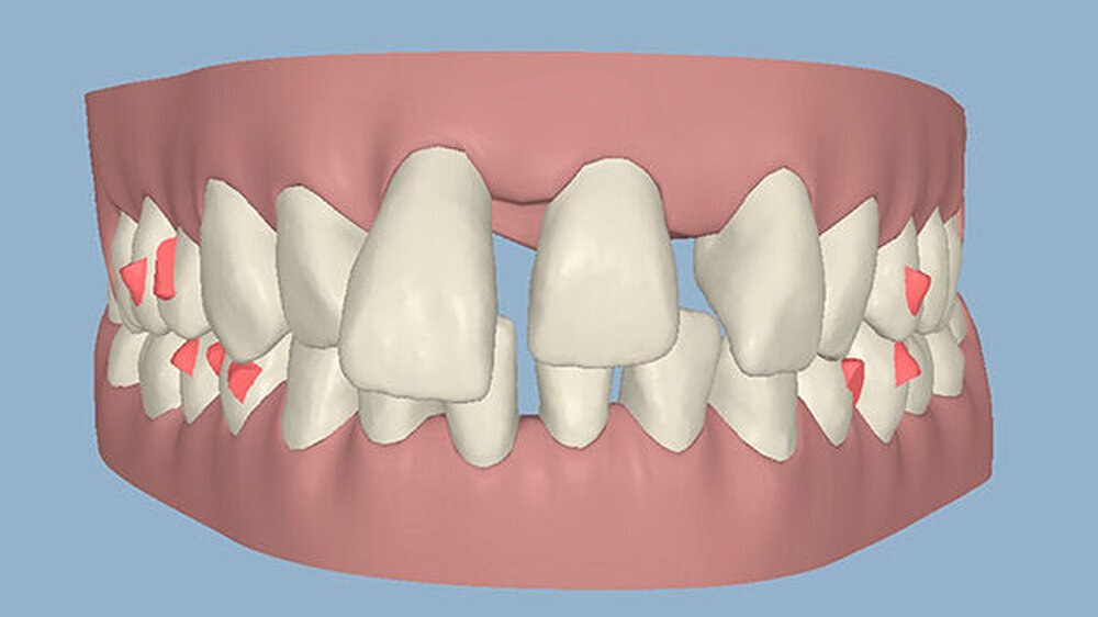 Abbildung 3a: Die Ausgangssituation im Clinical Check von Invisalign