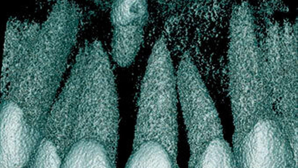 Abbildung 20: Überzähliger Zahn im Oberkieferfrontbereich (Mesiodens) mit einer konischen Form bei einem elfjährigen Mädchen mit Durchbruch in die Nasenhöhle (d: 3-dimensionale Bildrekonstruktion). |