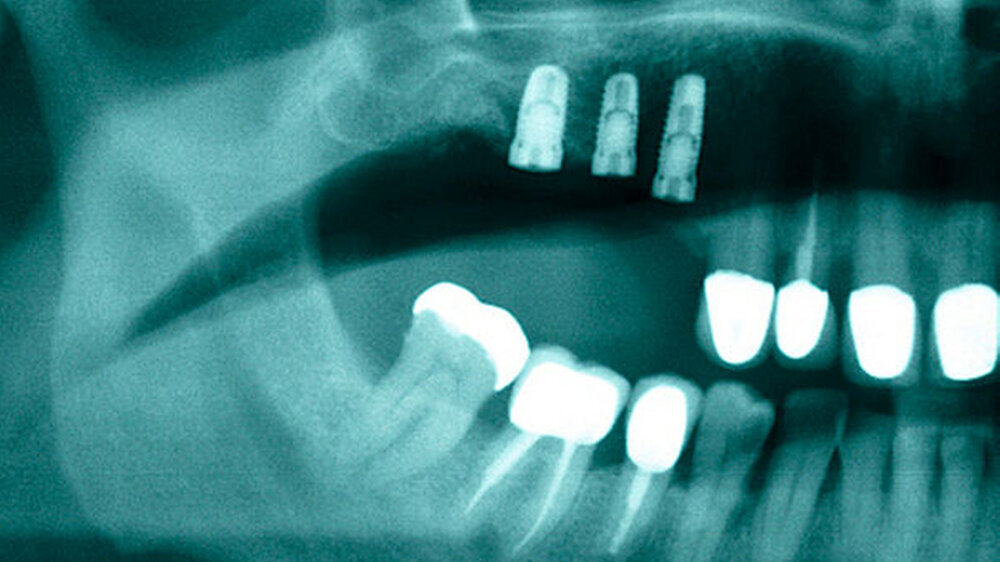 Archivbild aus dem Beitrag zm 10/2016 "Indikationen für die Prothetik - wie viele Implantate sind nötig?"