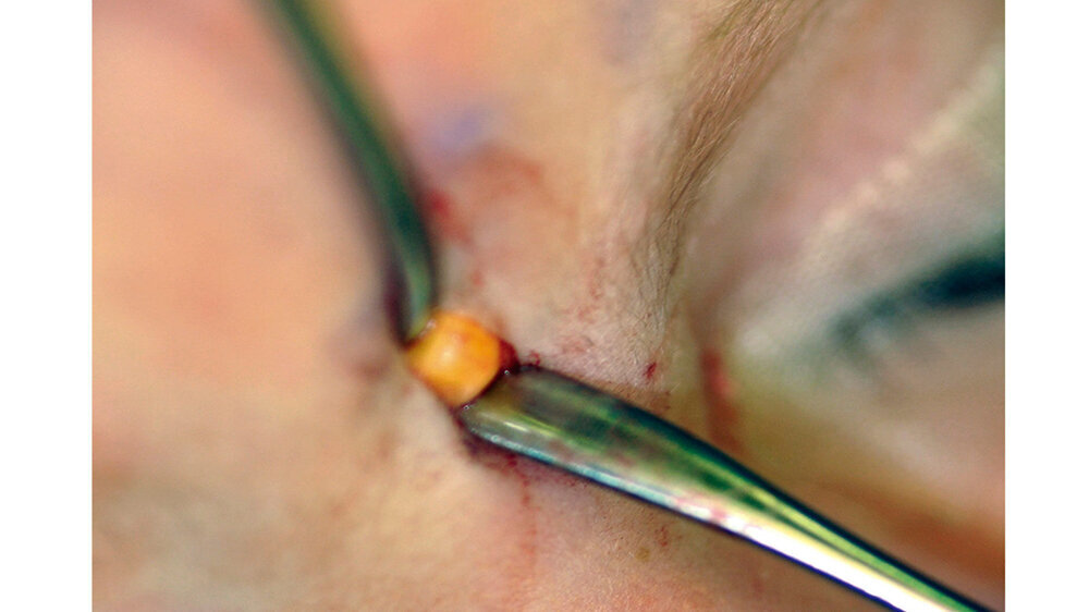 Die kindliche Epidermoidzyste an der Glabella konnte entfernt werden.