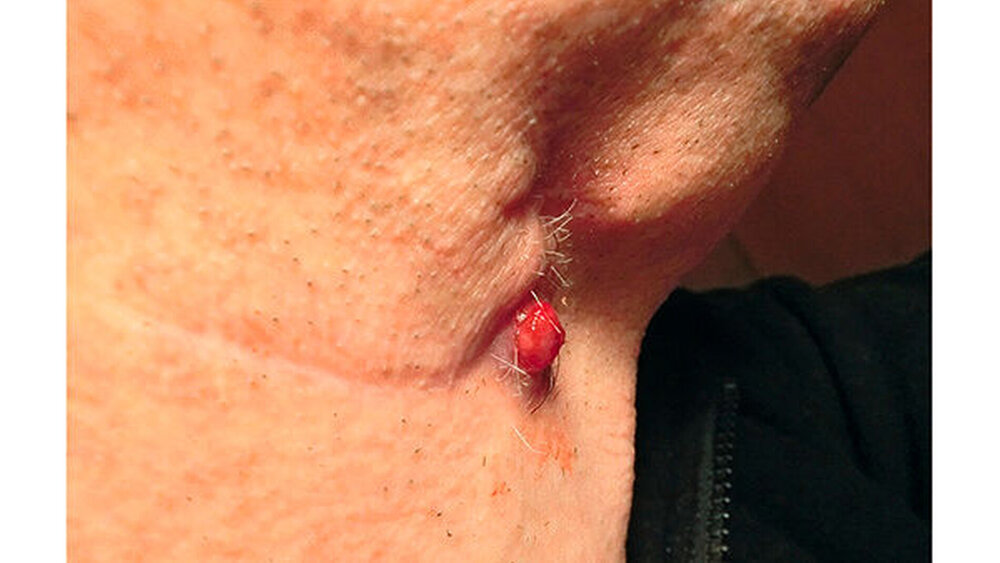 Abbildung 2: 20 Monate nach Beginn: Verätzung der Gewebewucherung mit Silbernitrat-Ätzstift („Höllenstein“). Eine weitere Verätzung mit Silbernitrat-Ätzstift folgt, zusammen mit einer Wundbehandlung mit Salben. |