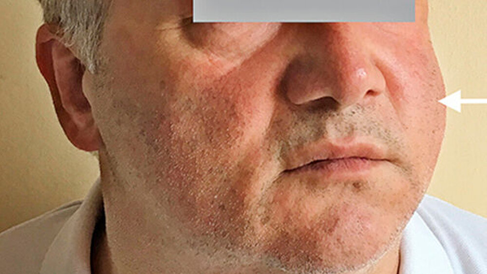 Abbildung 1a: Klinisches Bild Fall 1: Bilateral sichtbare Schwellung in den Bereichen Wange und Hals links, bei nach links gedrehtem Kopf. | Abbildung 1a: Klinisches Bild Fall 1: Bilateral sichtbare Schwellung in den Bereichen Wange und Hals links, bei nach links gedrehtem Kopf. |