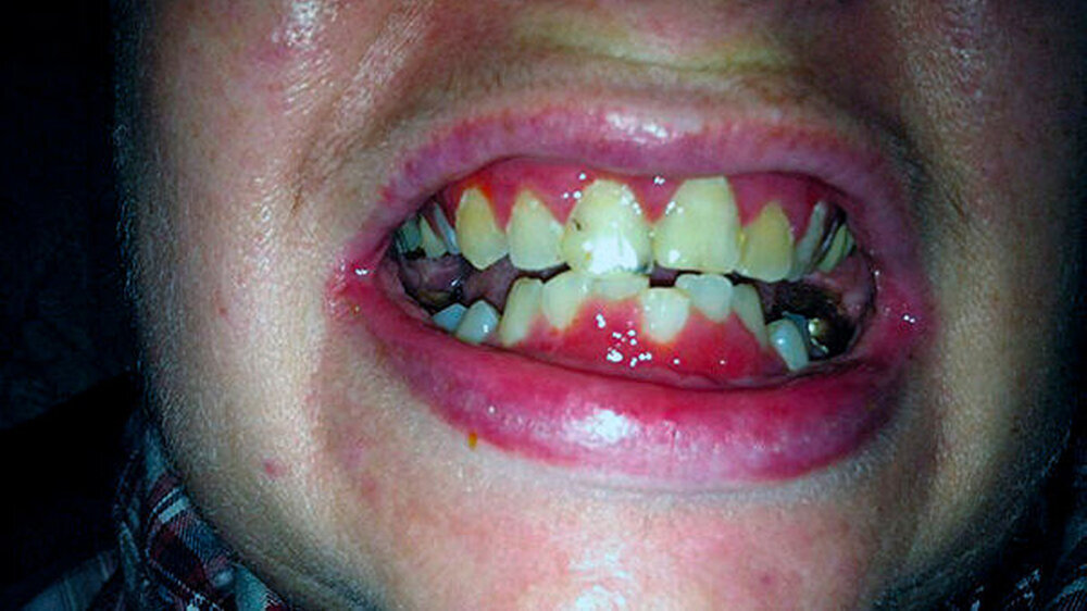 Abbildung 5: Gingivahyperplasie unter immunsuppressiver Therapie mit Ciclosporin A.