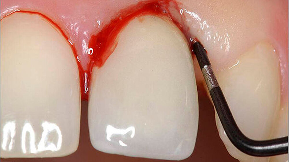 Diabetes stoppen: Bleeding on Probing ist ein gebräuliches Untersuchungsverfahren für die Diagnostik der perimplantären Mucositis oder Periimplantitis.\r\n